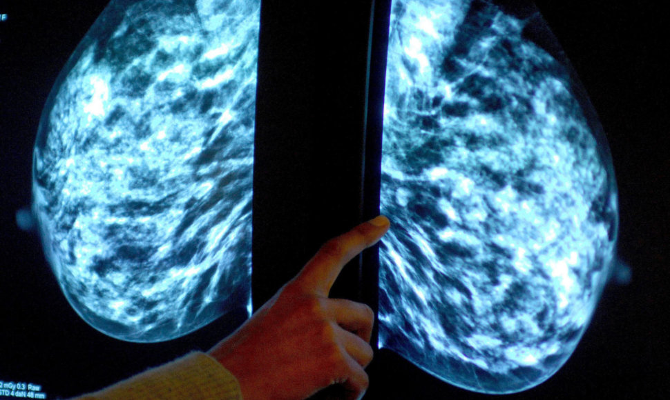 Mamogramos analizavimas