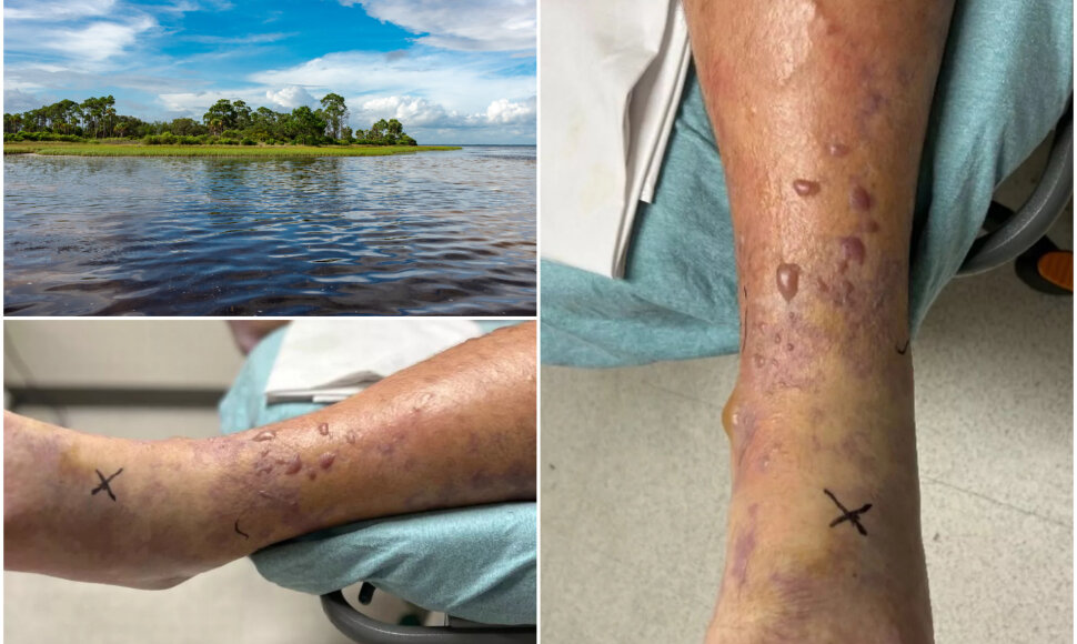 38-erių vyrą pakirto &bdquo;mėsą ėdanti&ldquo; infekcija
