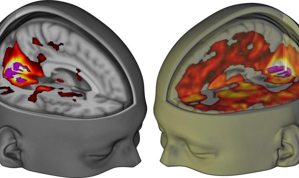 Smegenų palyginimas – kairėje pusėje – įprastai dirbančios žmogaus smegenys,dešinėje – paveiktos LSD
