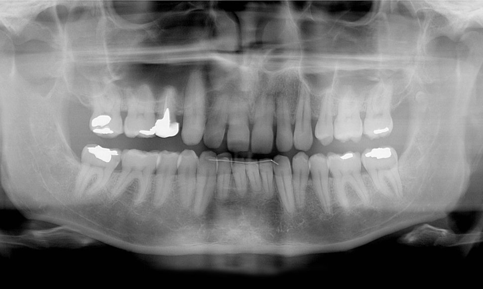 Dantų rentgeno nuotrauka