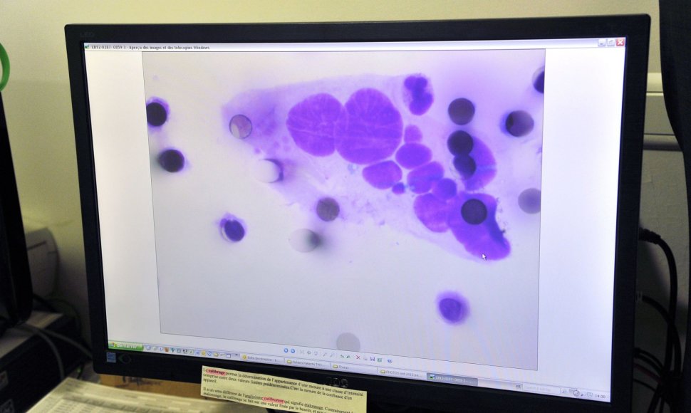 Vėžio ląstelės kompiuterio ekrane