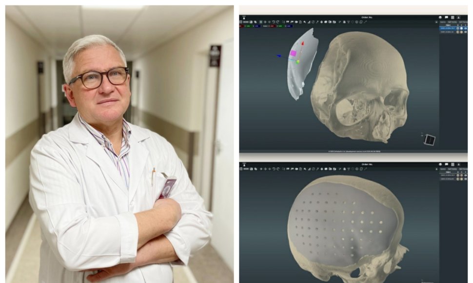 Gydytojas neurochirurgas Artūras Tamulis ir Kranialinių implantų modeliavimas 3D kompiuteriu