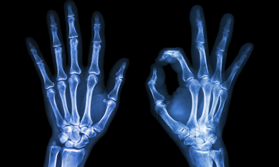 Žmogaus plaštakų rentgenograma