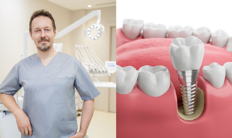 Kairėje – Doc. med. dr. Linas Zaleckas, „Denticija“ nuotr. Dešinėje – Dantų implantai, „Shutterstock“ nuotr.
