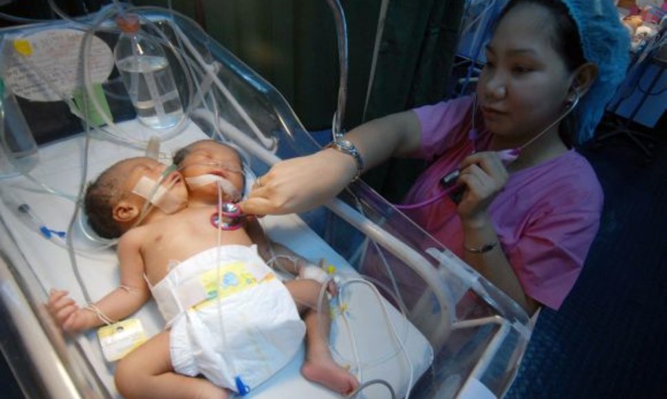 Filipinuose gimė mergaitė su dviem galvom