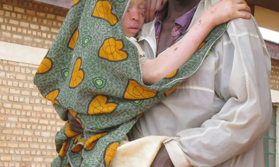Juodaodžiams albinosams iškilo mirtina grėsmė
