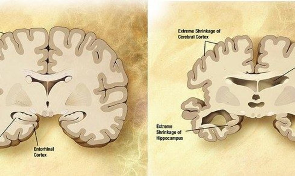 Smegenys ir Alzheimerio liga