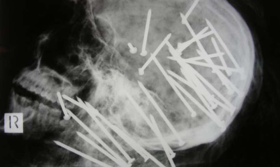 Kaukolės rentgeno nuotrauka