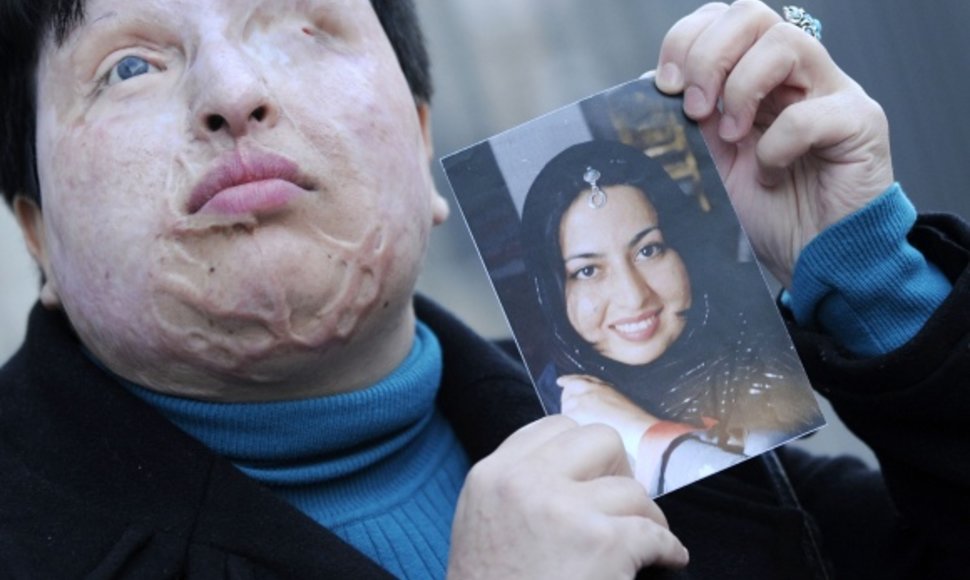 Ameneh Bahrami laiko nuotrauką, kurioje ji užfiksuota prieš užpuolimą, kai jos veidas ir akys buvo apipiltos rūgštimi.