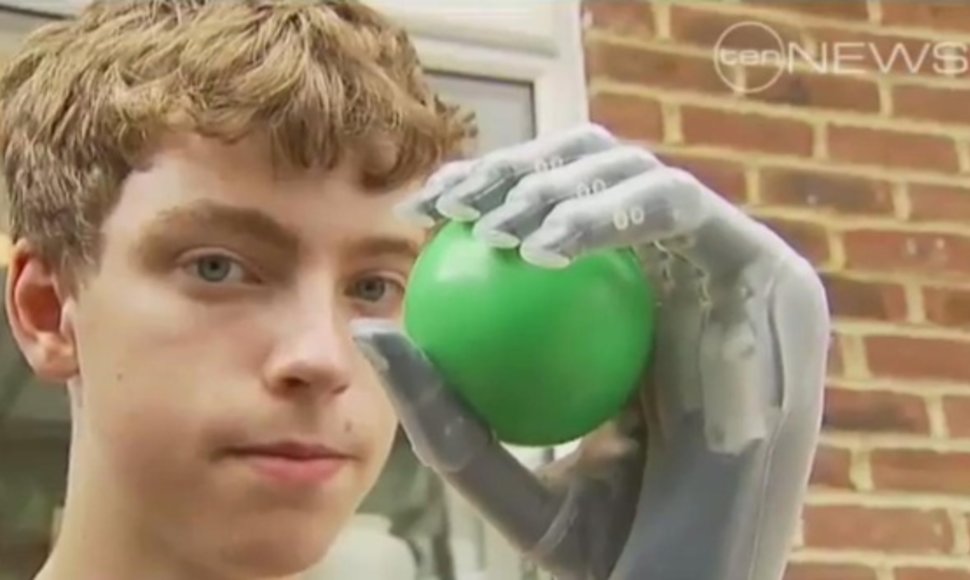 Matthew Jamesas ilgus metus svajojo įsigyti bioninę ranką.