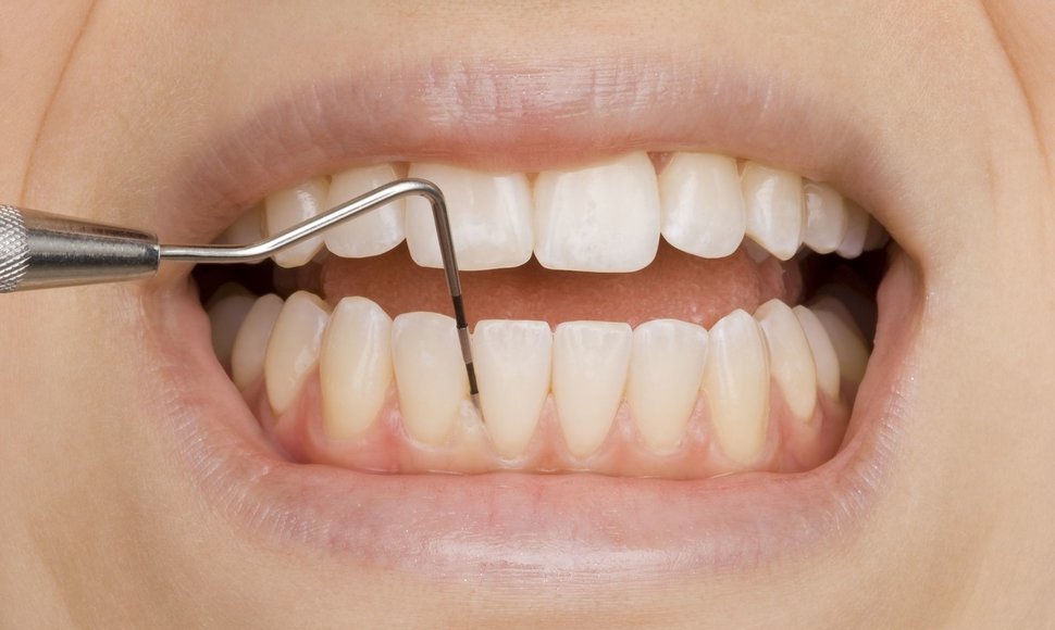 Dantų ir burnos higiena ypač svarbi parodontozės prevencijai