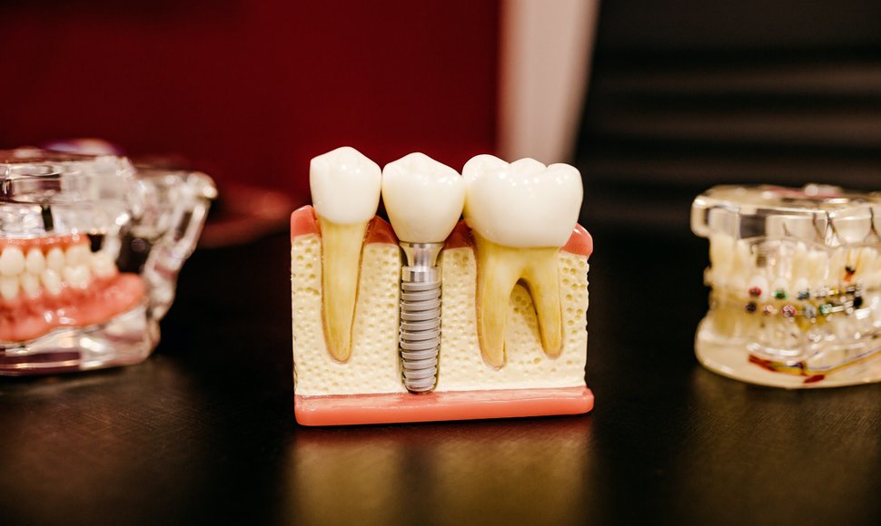 Dantų implantas