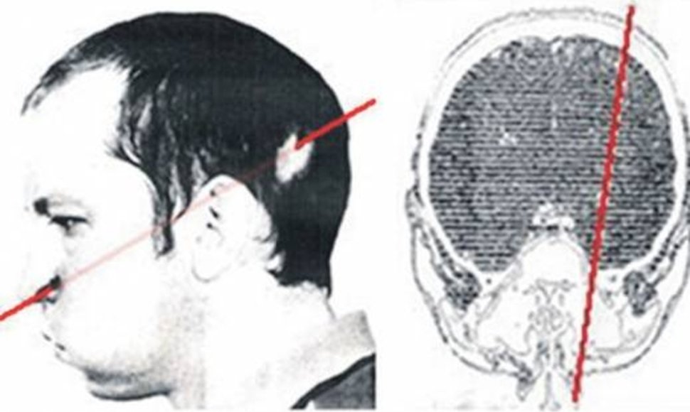 Protonų spindulys pirmiausiai persmelkė mokslininko pakaušį ties kairiąja ausimi, visą kaukolę ir išlindo maždaug ties nosimi 