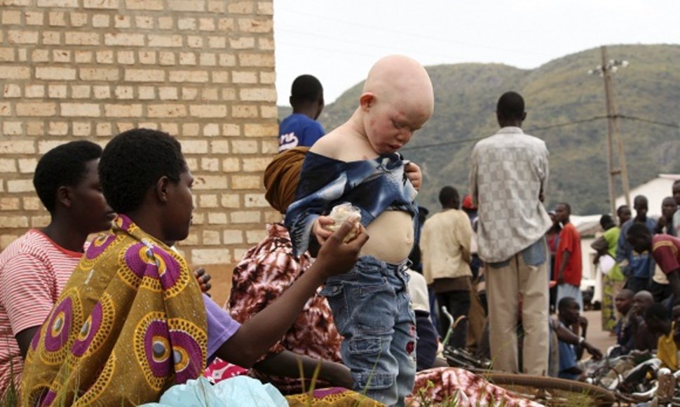 Albinosas afrikietis