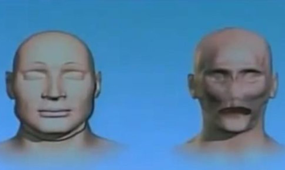 Jungtinėse Valstijose pirmą kartą sėkmingai atlikta viso veido persodinimo procedūra