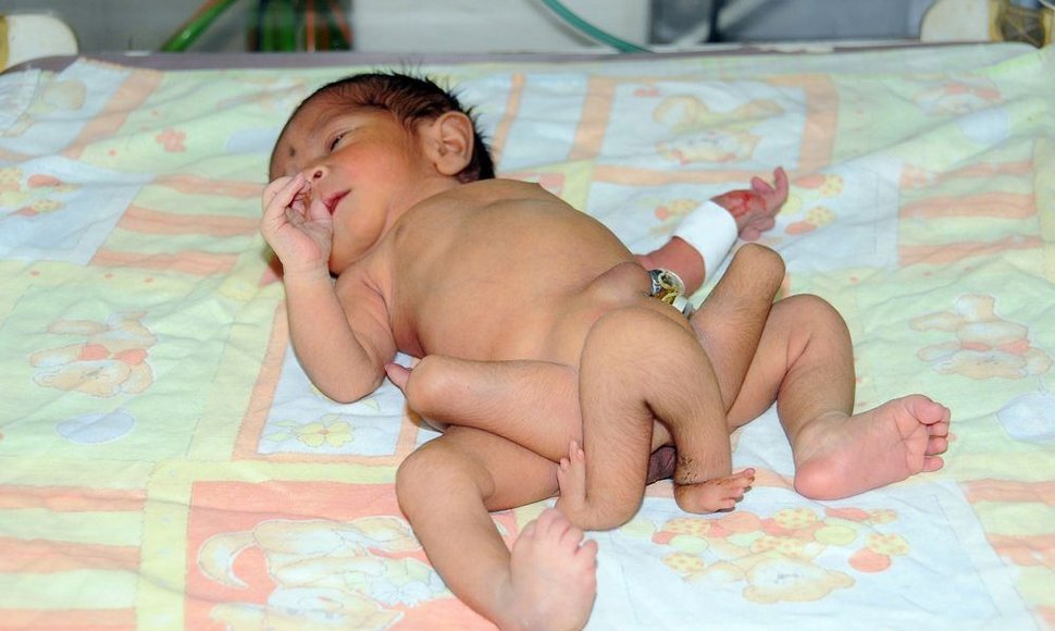 Pakistano medikai išgelbėjo kūdikio su šešiomis kojomis gyvybę.