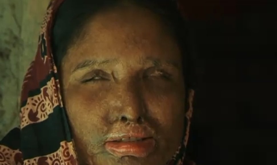 Bangladeše gyvenančiai Nurbanu vyras veidą apipylė rūgštimi