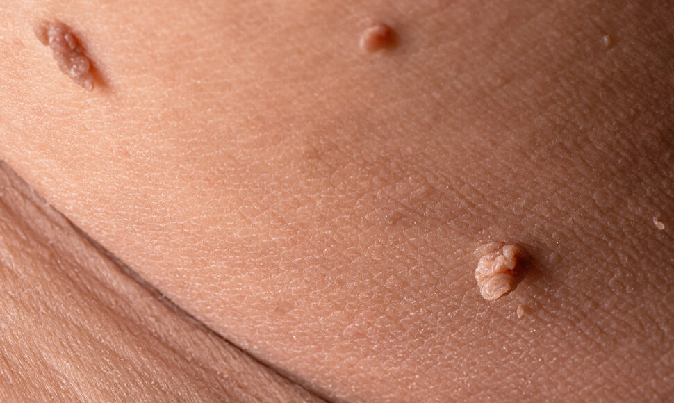 Fibromos