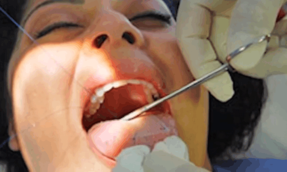 Pacientei ant liežuvio siuvamas normalią mitybą trikdantis plastikinis tinklelis