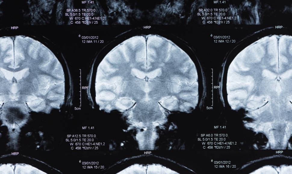Smegenų tyrimas magnetiniu rezonansu 