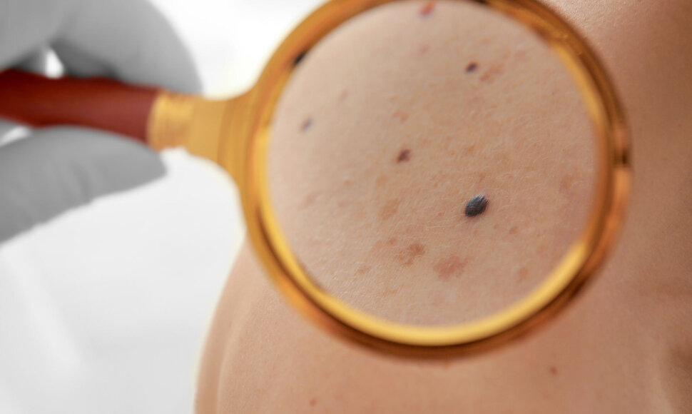 Melanoma