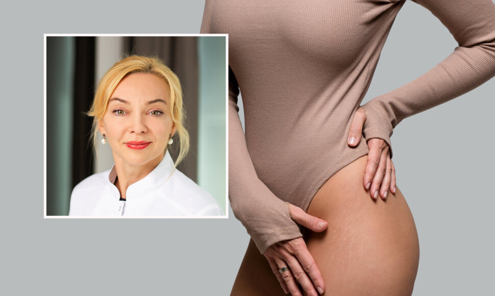 Gydytoja dermatovenerologė Eglė Auk&scaron;tuolienė kalba apie strijas