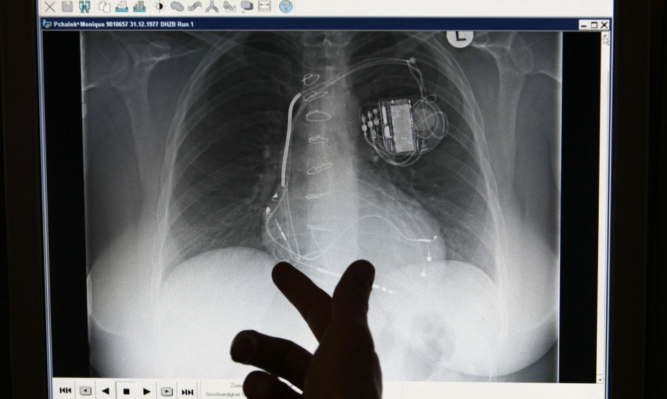 Implantuojamo defibriliatoriaus rentgeno nuotrauka