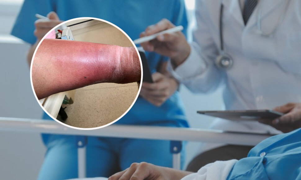 Atostogų metu moteris pasigavo celiulito infekciją