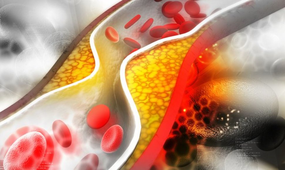 Cholesterolis kemša kraujagysles