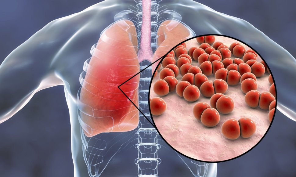Pneumonija plaučiuose