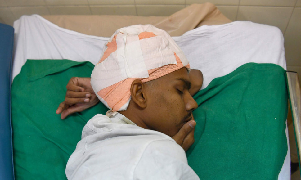 Indijos chirurgai pacientui pašalino sunkiausią žinomą smegenų auglį