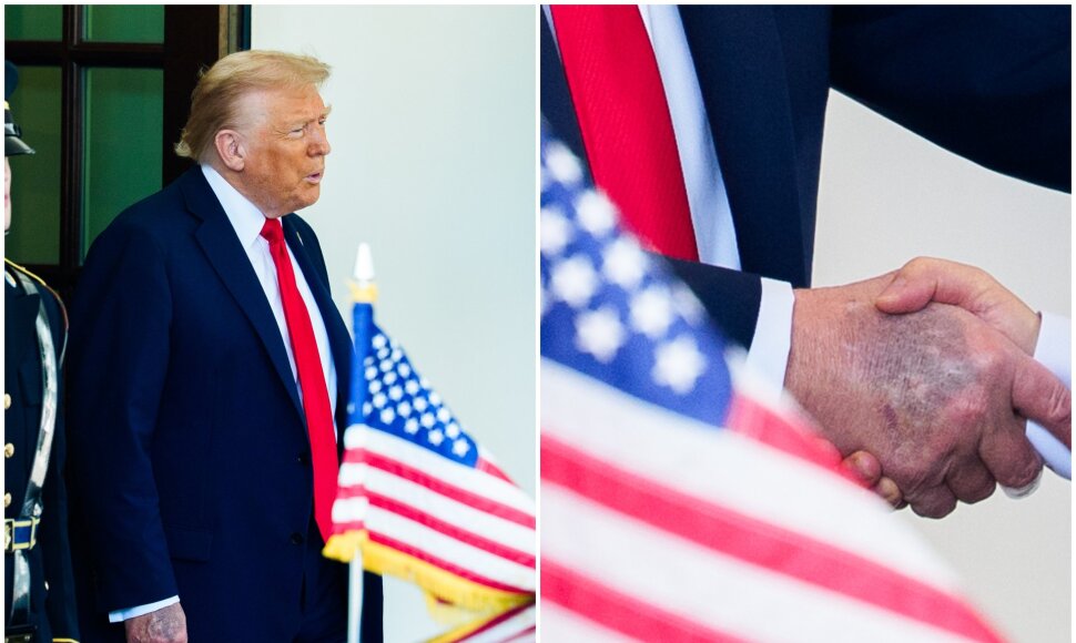 Prezidento Donaldo Trumpo ranka su kraujosruva 