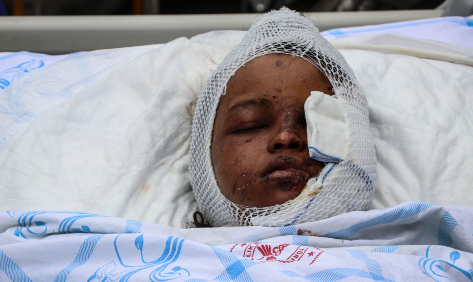 Per sprogdinimą Somalyje sužeista mergaitė