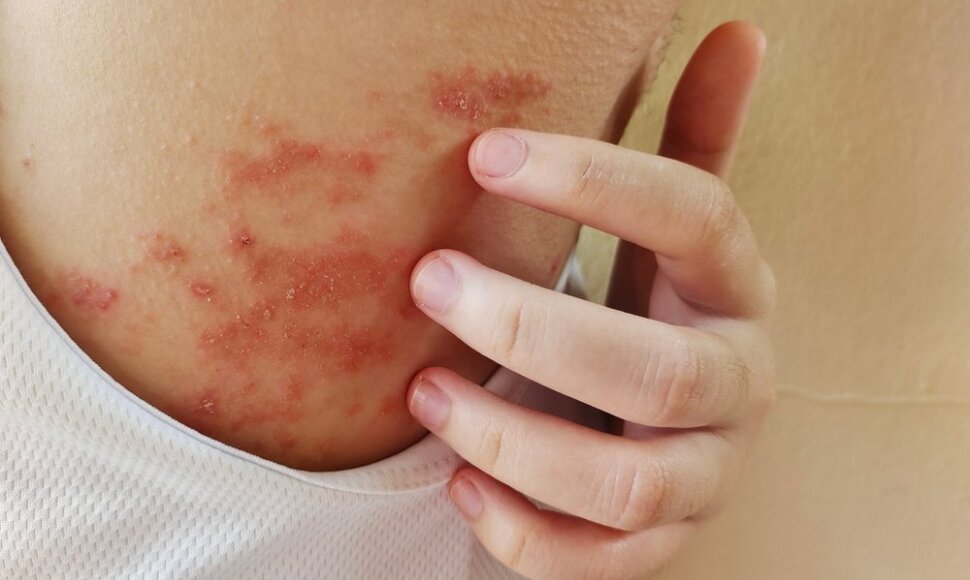 Atopinis dermatitas