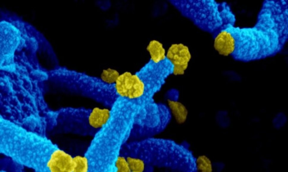 Iš pacientės gerklės tepinėlių paimtas virusas gebėjo daugintis laboratorinėje žmogaus ląstelių terpėje