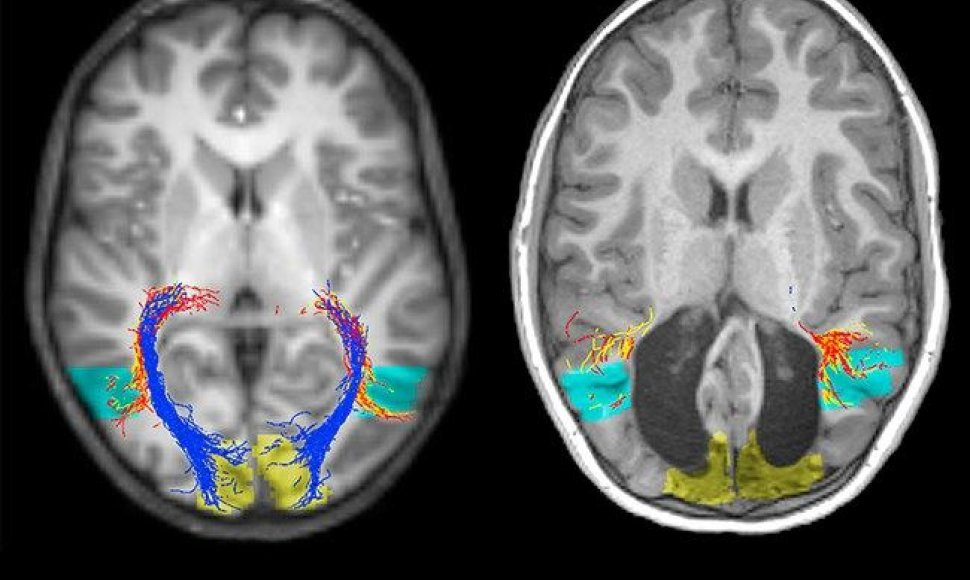 Normalios smegenys (kairėje) ir berniuko, neturinčio regos žievės, smegenys