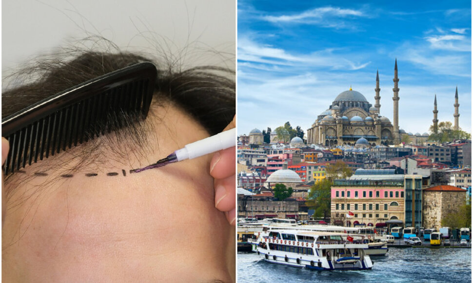 Į Turkiją dėl plaukų persodinimo kasmet atvyksta daugiau nei milijonas turistų