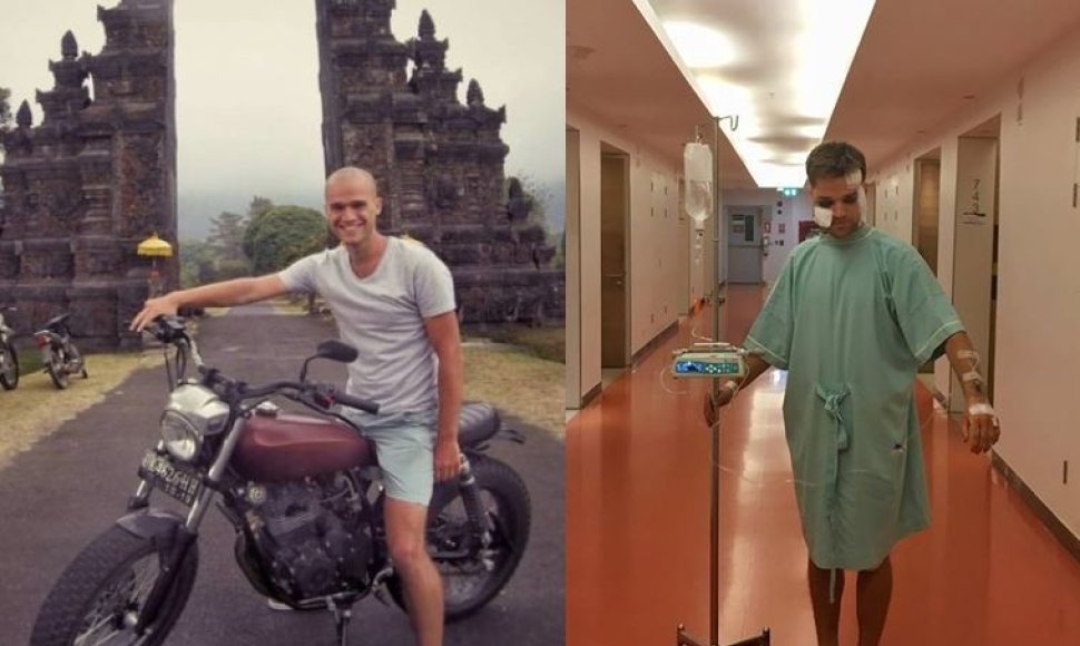 Jokūbas Laukaitis Balio saloje (kairėje) ir Tailande po avarijos